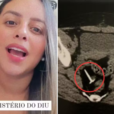 mulher-vai-a-hospital-com-colica-renal-e-descobre-que-diu-‘desaparecido’-ha-tres-anos-esta-perto-do-intestino